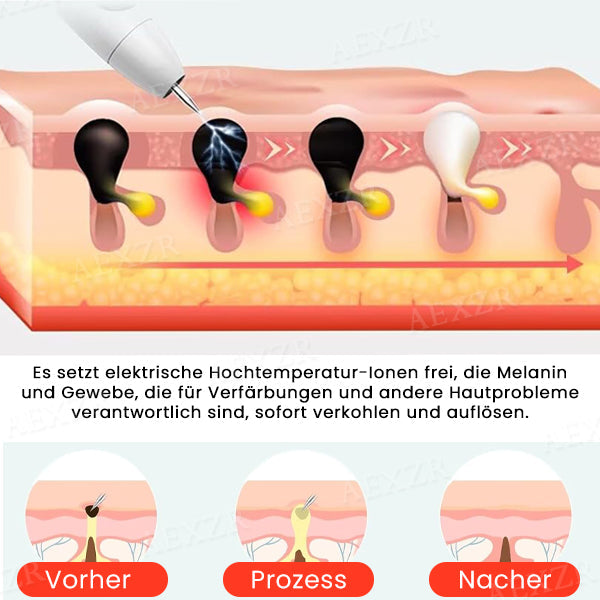 Hudfil™ 🔥 2025 Neuestes Modell🔥𝔾𝕖𝕟𝕚𝕖ß𝕖𝕟 𝕊𝕚𝕖 𝟟𝟘 % 🆁🅰🅱🅰🆃🆃 - Tragbarer Hautpflege-Laserstift
