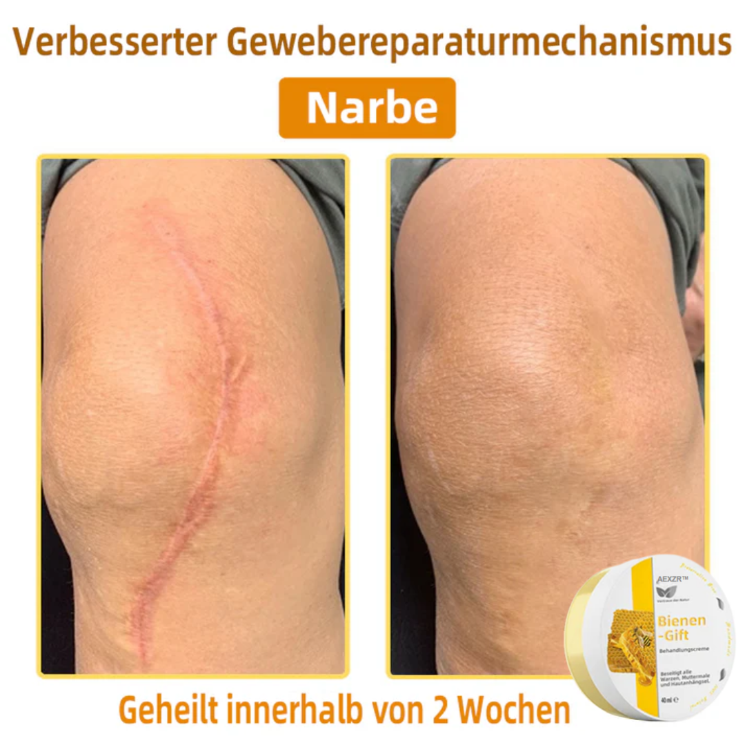 AEXZR™ Bienengift-Therapie-Creme, zur Behandlung von Ekzemen, Akne, Altersflecken, Krampfadern, Hautrissen