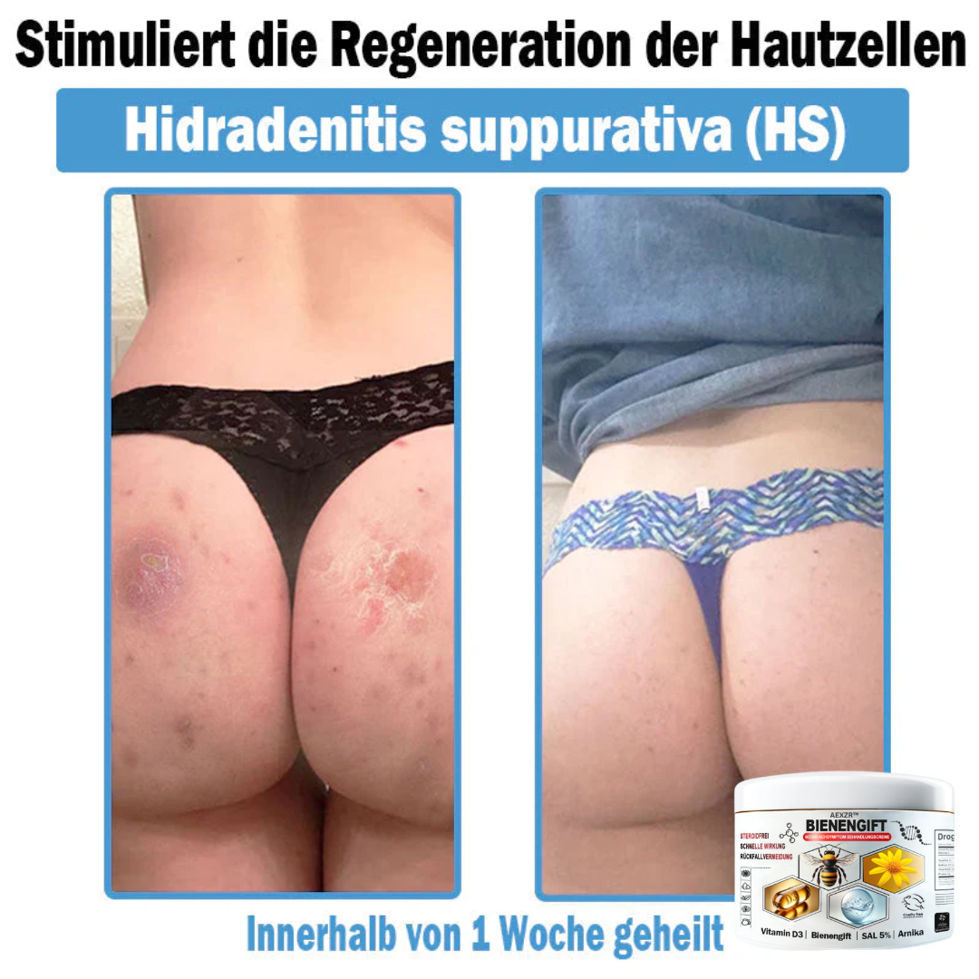 AEXZR™🌿 Bienengift Multisymptom Behandlungsscreme (👨⚕DDG Empfohlen)