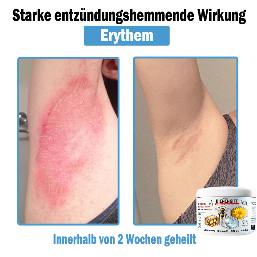 AEXZR™🌿 Bienengift Multisymptom Behandlungsscreme (👨⚕DDG Empfohlen)