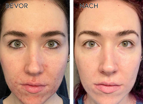 AEXZR™ ClearAcne Abwehr Gel