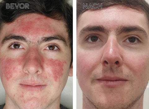 AEXZR™ ClearAcne Abwehr Gel