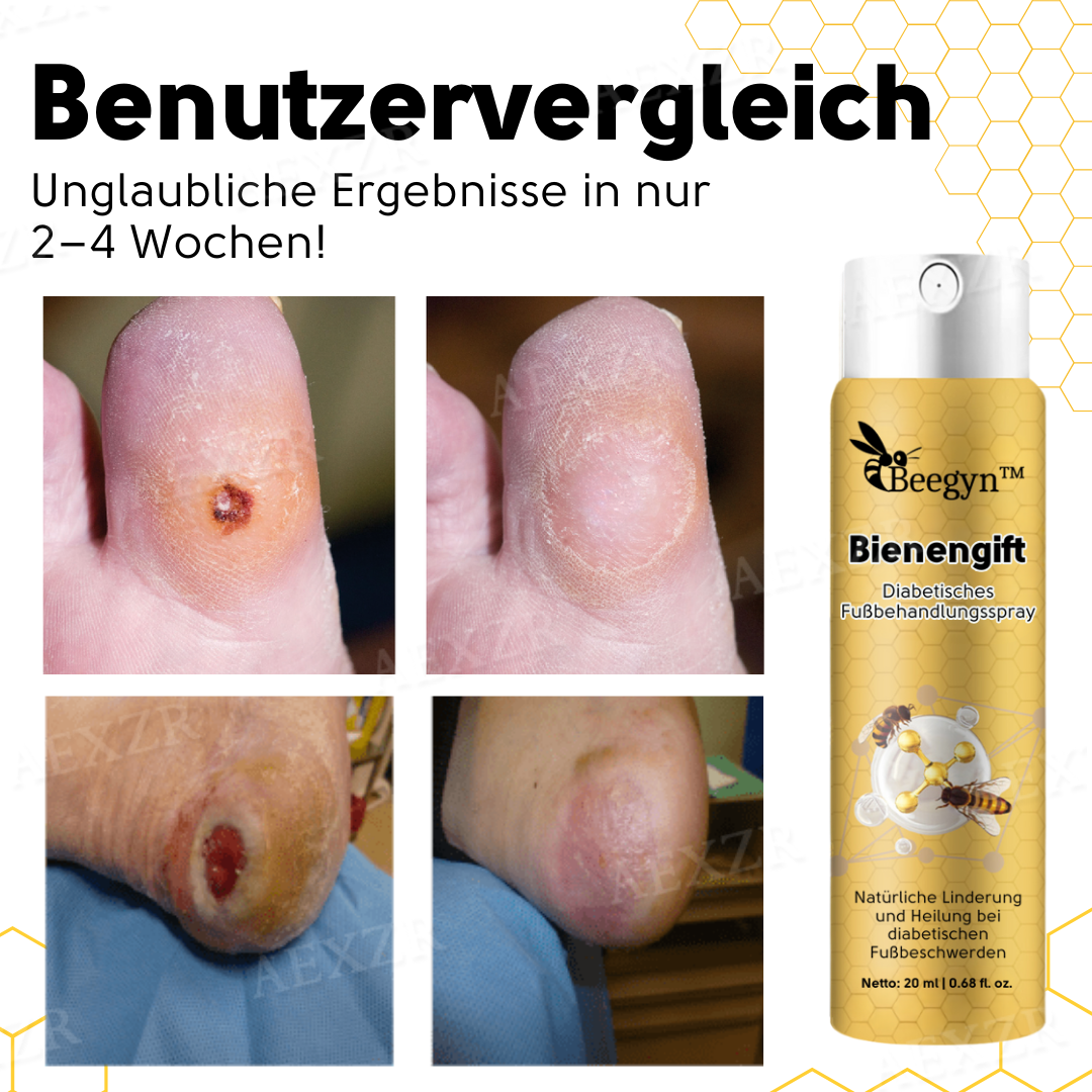 Beegyn™ Bienengift Diabetisches Fußbehandlungsspray