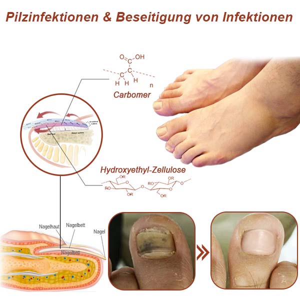 Bikenda® Revolutionäres hocheffizientes Lichttherapiegerät für Zehennagelerkrankungen (⭐⭐⭐⭐⭐ Begrenzter Rabatt für 30 Minuten)