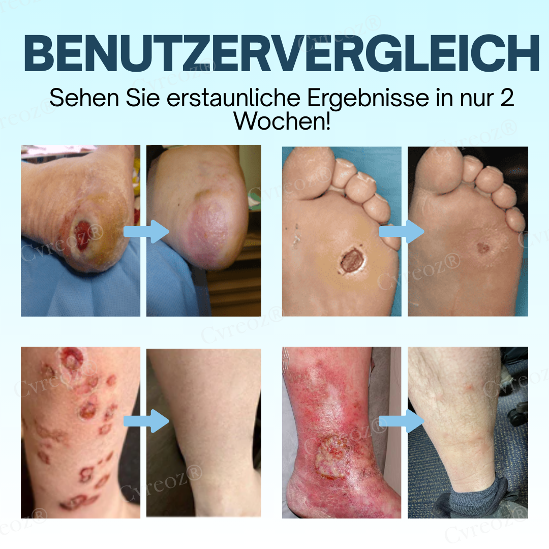 Cvreoz® Diabetes Behandlungscreme