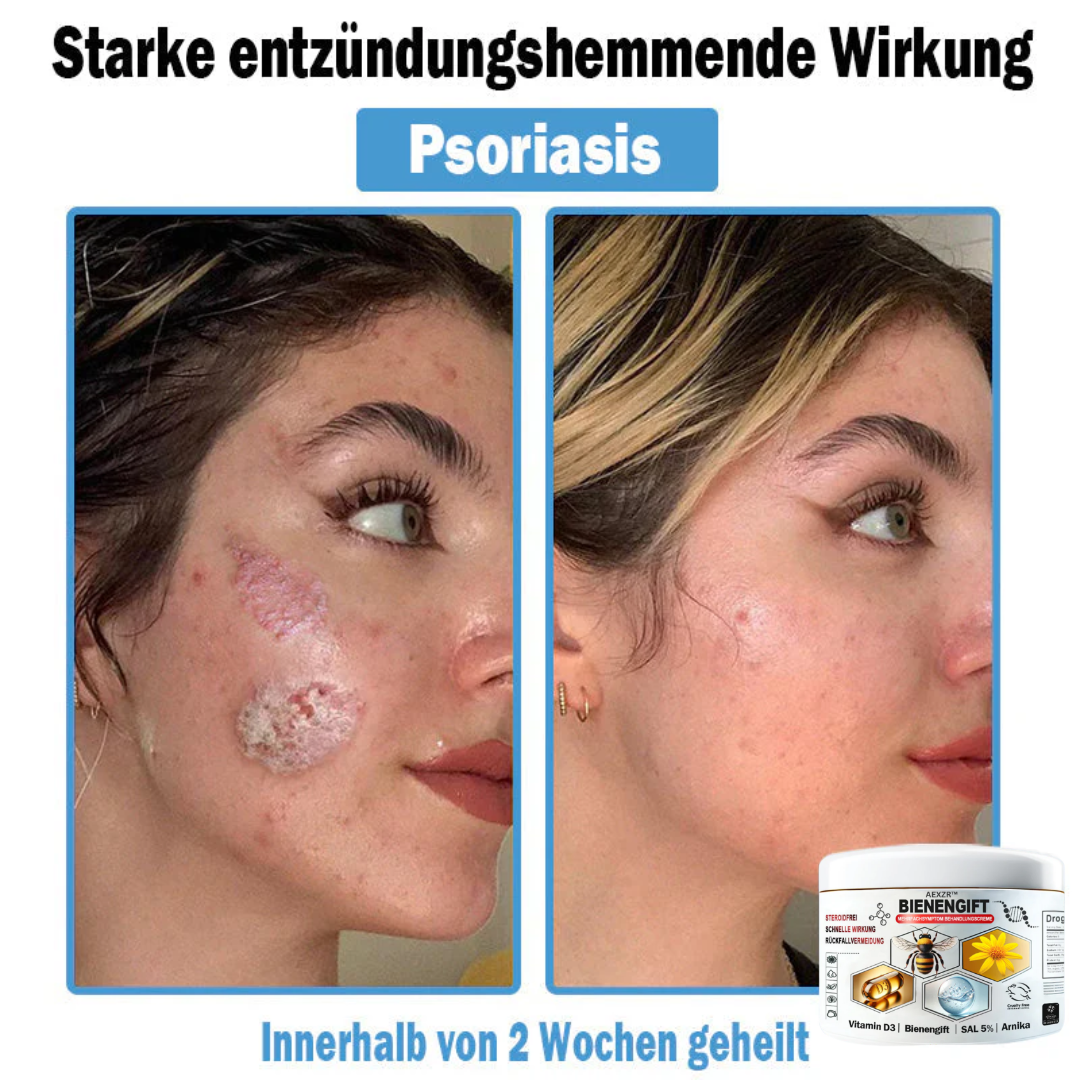 AEXZR™🌿 Bienengift Multisymptom Behandlungsscreme (👨⚕DDG Empfohlen)
