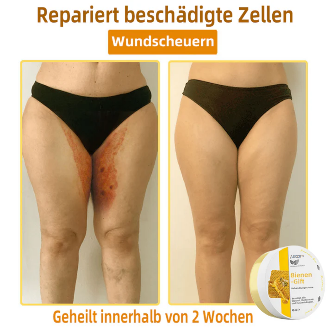 AEXZR™ Bienengift-Therapie-Creme, zur Behandlung von Ekzemen, Akne, Altersflecken, Krampfadern, Hautrissen