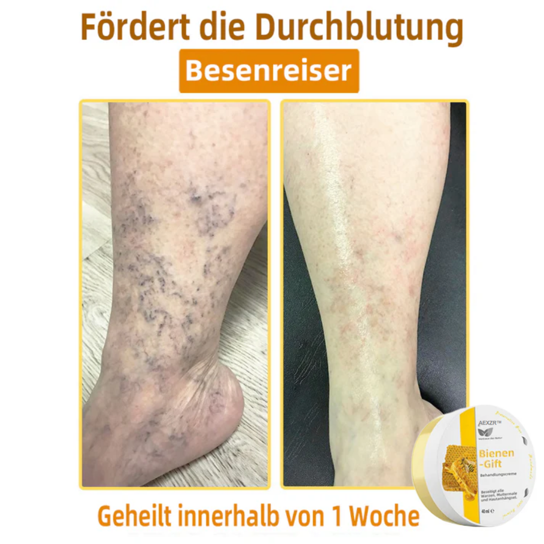 AEXZR™ Bienengift-Therapie-Creme, zur Behandlung von Ekzemen, Akne, Altersflecken, Krampfadern, Hautrissen