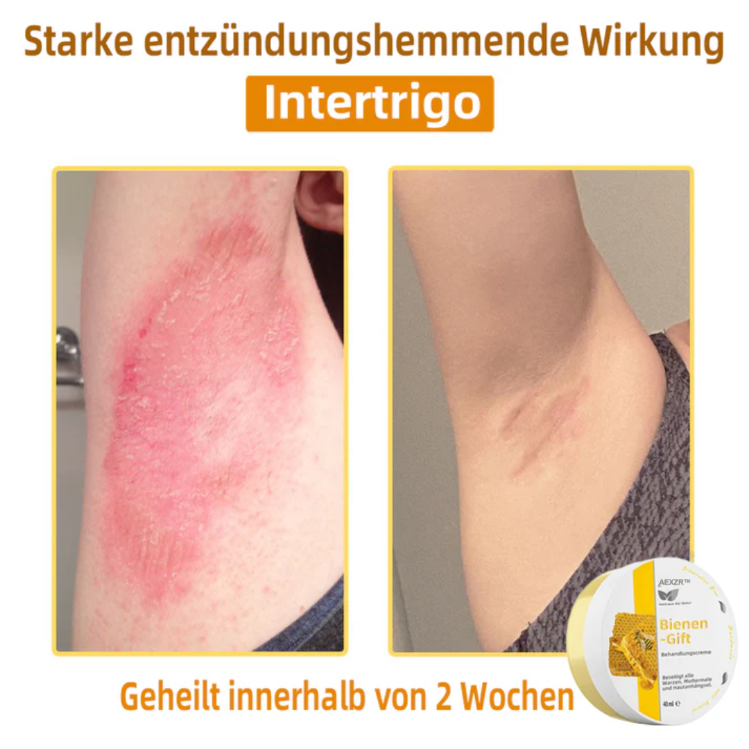 AEXZR™ Bienengift-Therapie-Creme, zur Behandlung von Ekzemen, Akne, Altersflecken, Krampfadern, Hautrissen