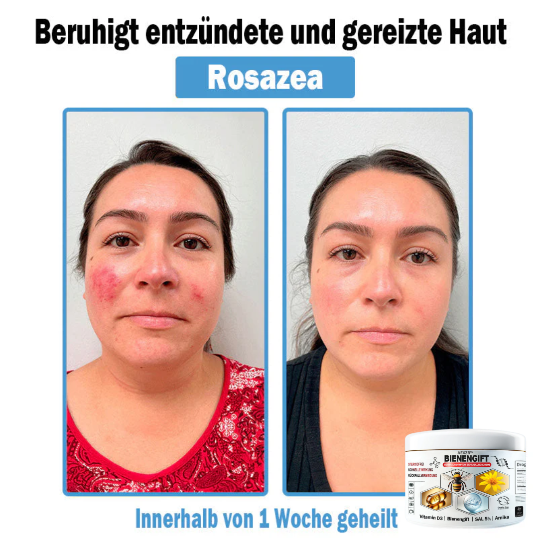 AEXZR™🌿 Bienengift Multisymptom Behandlungsscreme (👨⚕DDG Empfohlen)