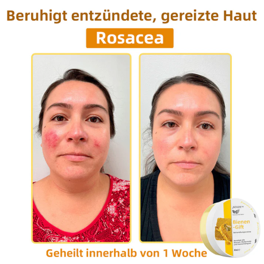 AEXZR™ Bienengift-Therapie-Creme, zur Behandlung von Ekzemen, Akne, Altersflecken, Krampfadern, Hautrissen
