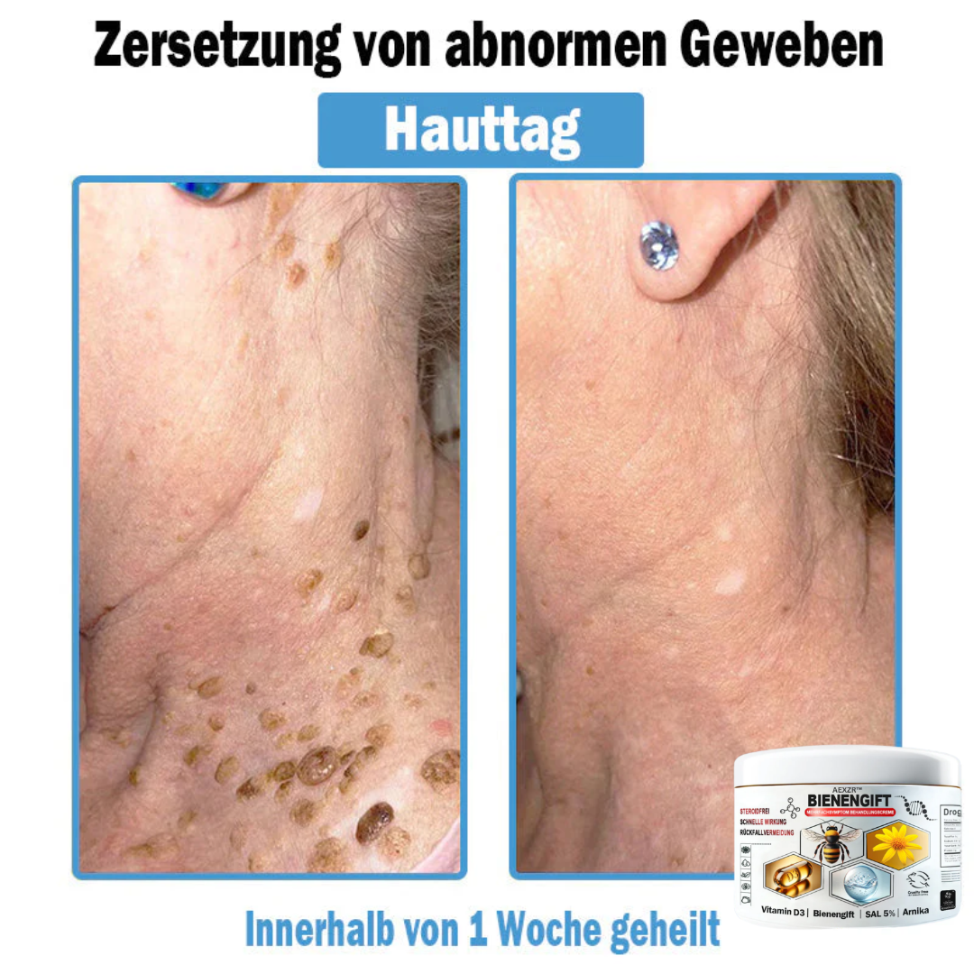 AEXZR™🌿 Bienengift Multisymptom Behandlungsscreme (👨⚕DDG Empfohlen)