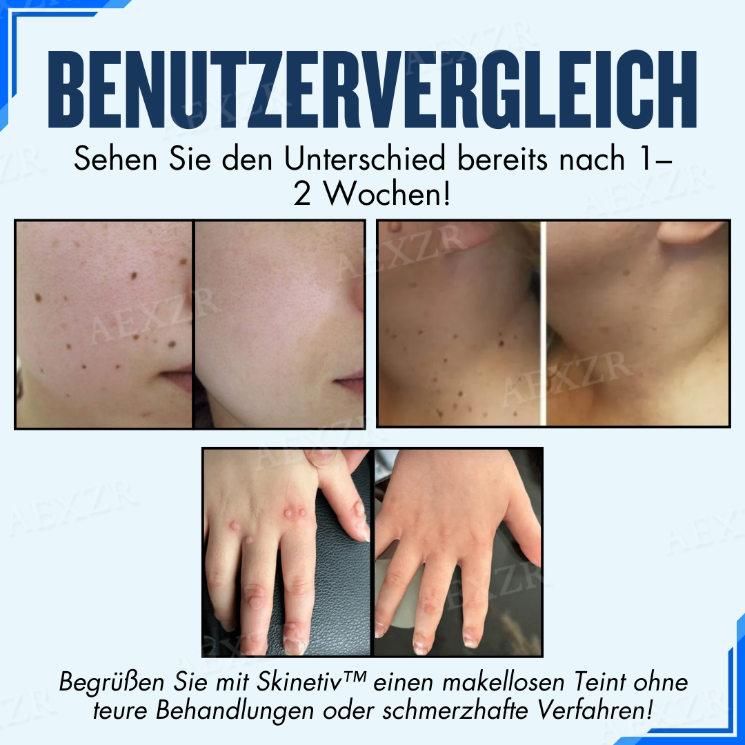 Skinetiv™ Maulwürfe & Warzen entfernen Haut-Tag-Pflaster