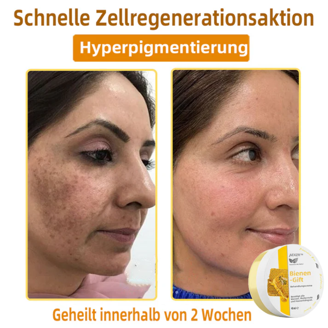 AEXZR™ Bienengift-Therapie-Creme, zur Behandlung von Ekzemen, Akne, Altersflecken, Krampfadern, Hautrissen