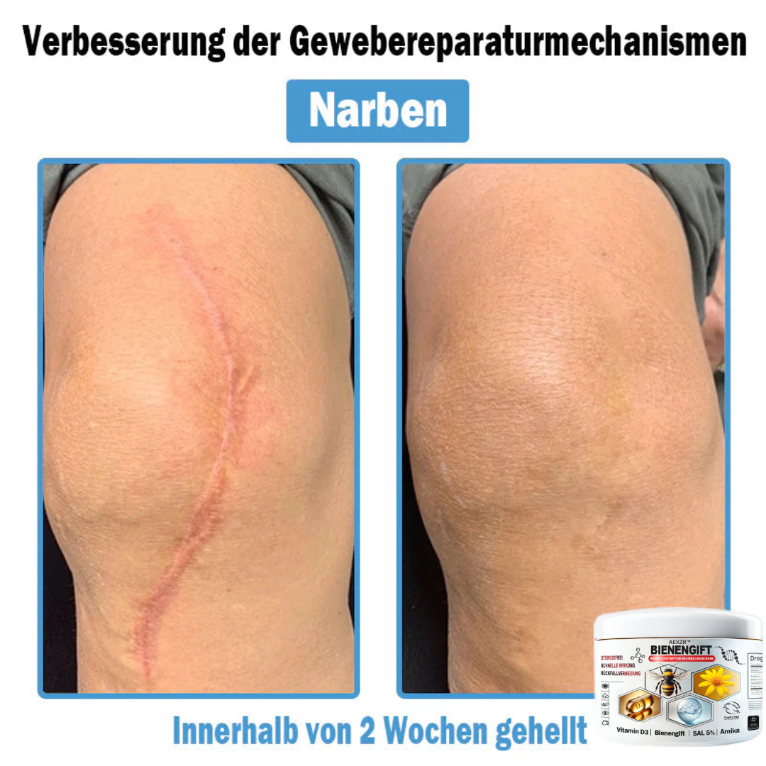 AEXZR™🌿 Bienengift Multisymptom Behandlungsscreme (👨⚕DDG Empfohlen)