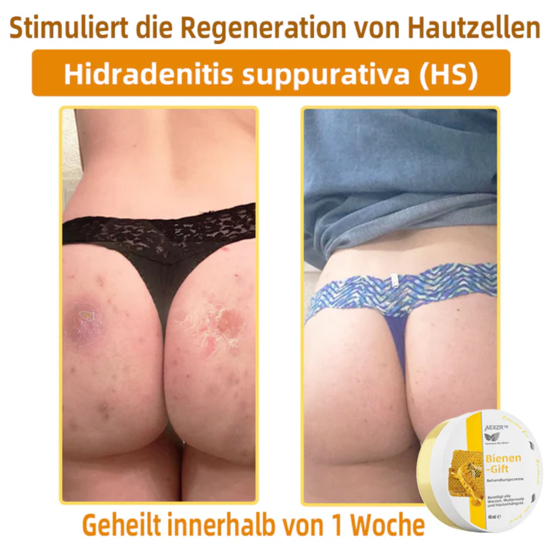 AEXZR™ Bienengift-Therapie-Creme, zur Behandlung von Ekzemen, Akne, Altersflecken, Krampfadern, Hautrissen