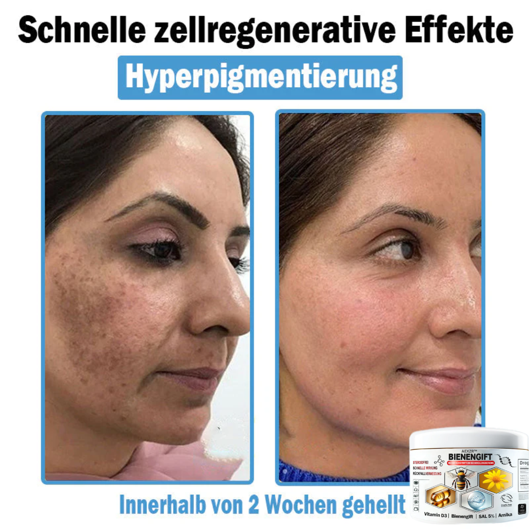 AEXZR™🌿 Bienengift Multisymptom Behandlungsscreme (👨⚕DDG Empfohlen)