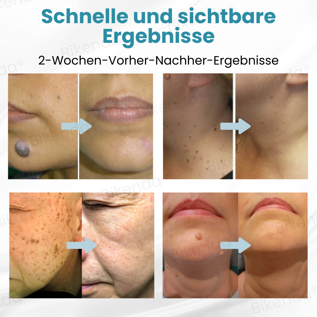 Bikenda® Nicht-invasive Muttermal- und Warzenbehandlung Laserstift zum Entfernen