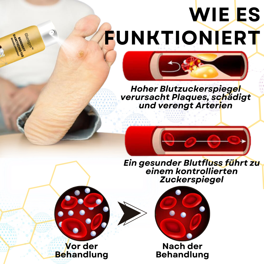 2024 HEISSER VERKAUF🔥Glucogyn™ Bienengift Diabetischer Fuß Behandlungsspray🔥