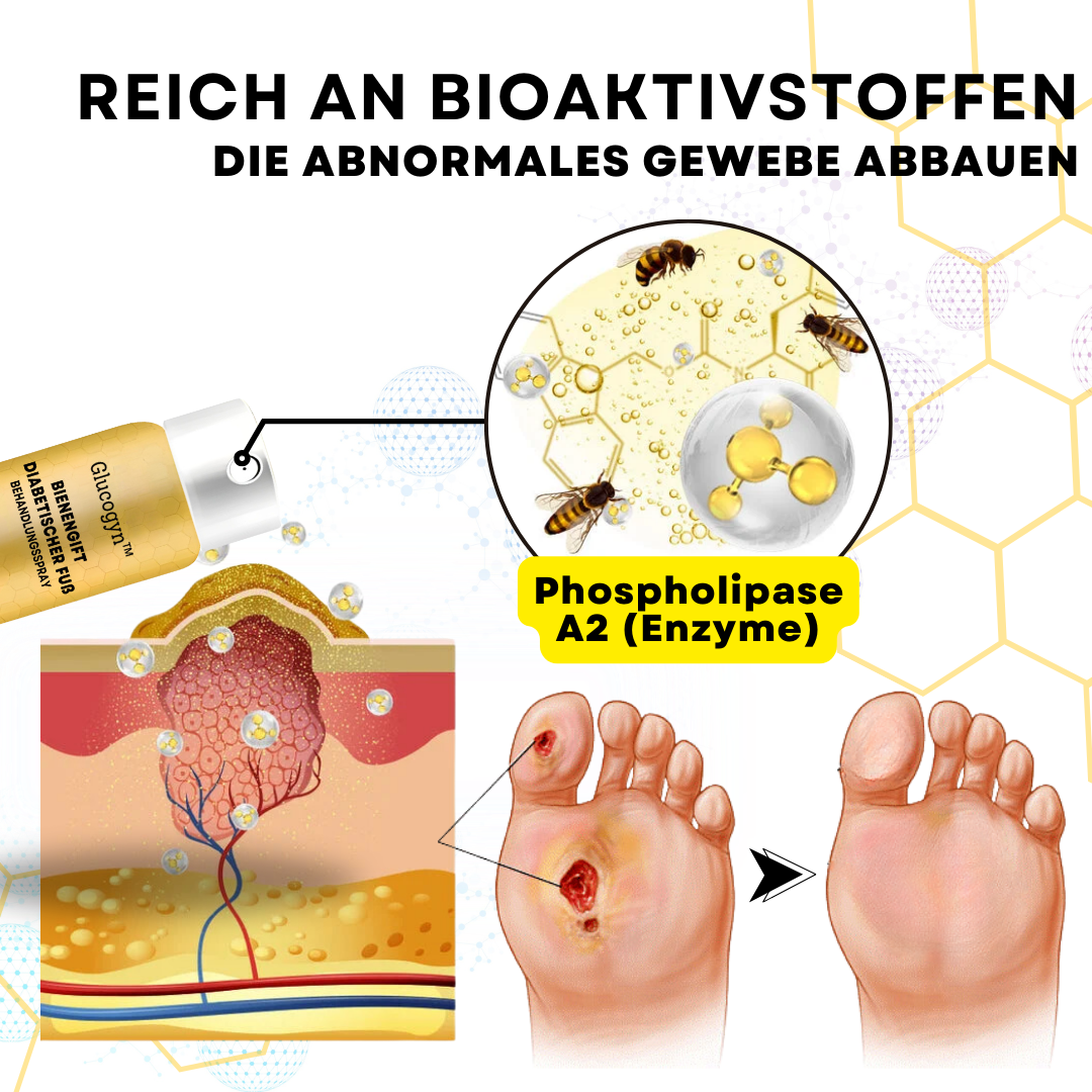 2024 HEISSER VERKAUF🔥Glucogyn™ Bienengift Diabetischer Fuß Behandlungsspray🔥
