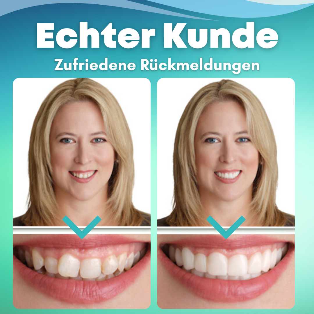 🔥2024 HEISSER VERKAUF🔥EzySmile™ SnapOn Silikon Veneers