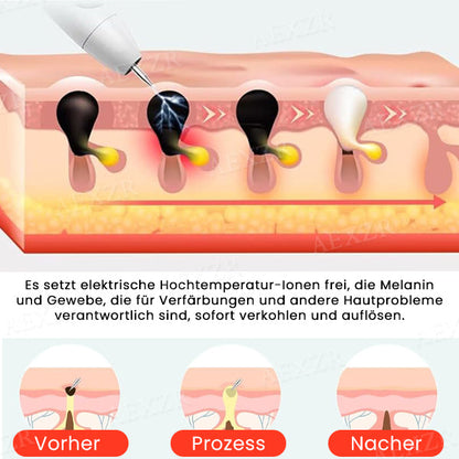 Hudfil™ 🔥 2025 Neuestes Modell🔥𝔾𝕖𝕟𝕚𝕖ß𝕖𝕟 𝕊𝕚𝕖 𝟟𝟘 % 🆁🅰🅱🅰🆃🆃 - Tragbarer Hautpflege-Laserstift