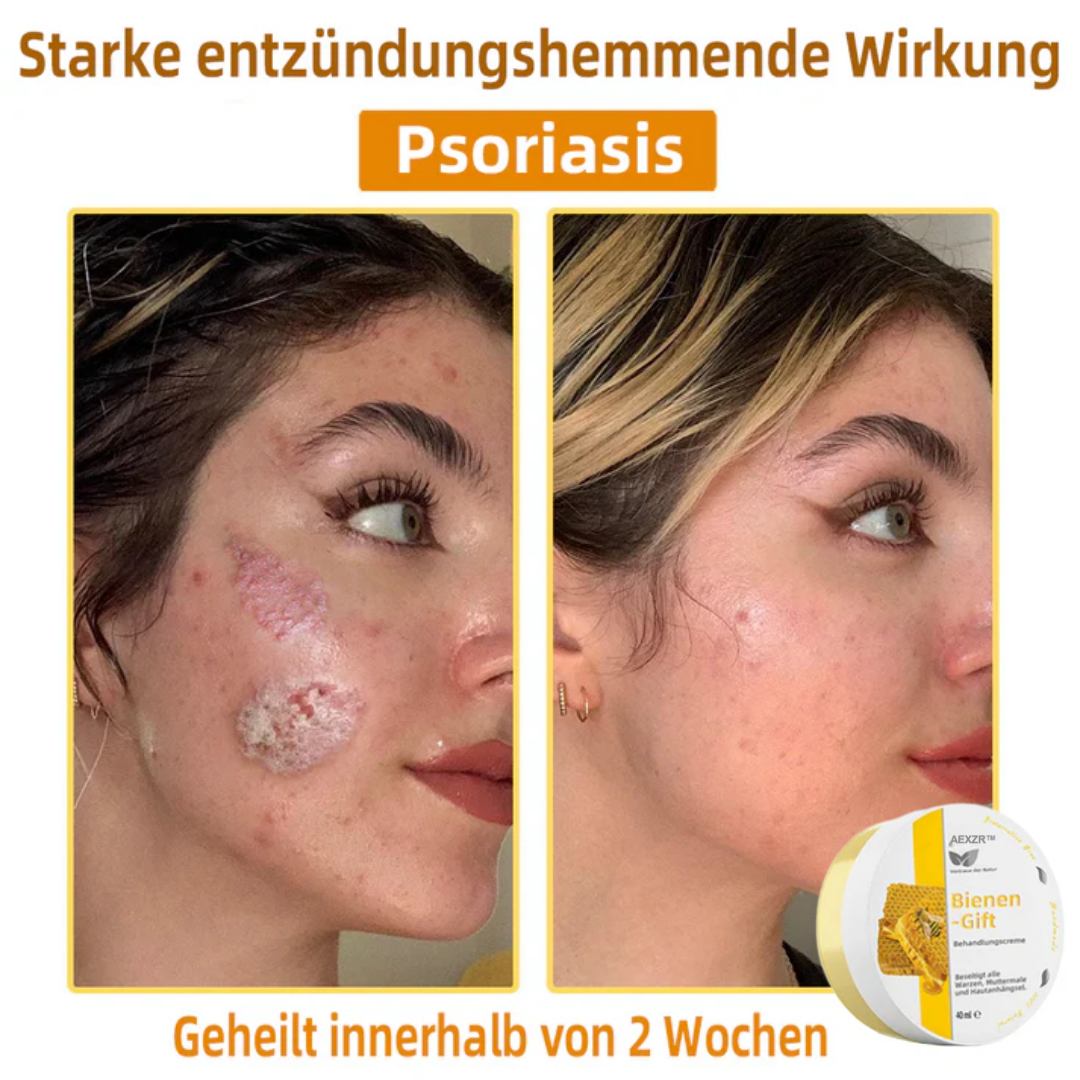 AEXZR™ Bienengift-Therapie-Creme, zur Behandlung von Ekzemen, Akne, Altersflecken, Krampfadern, Hautrissen