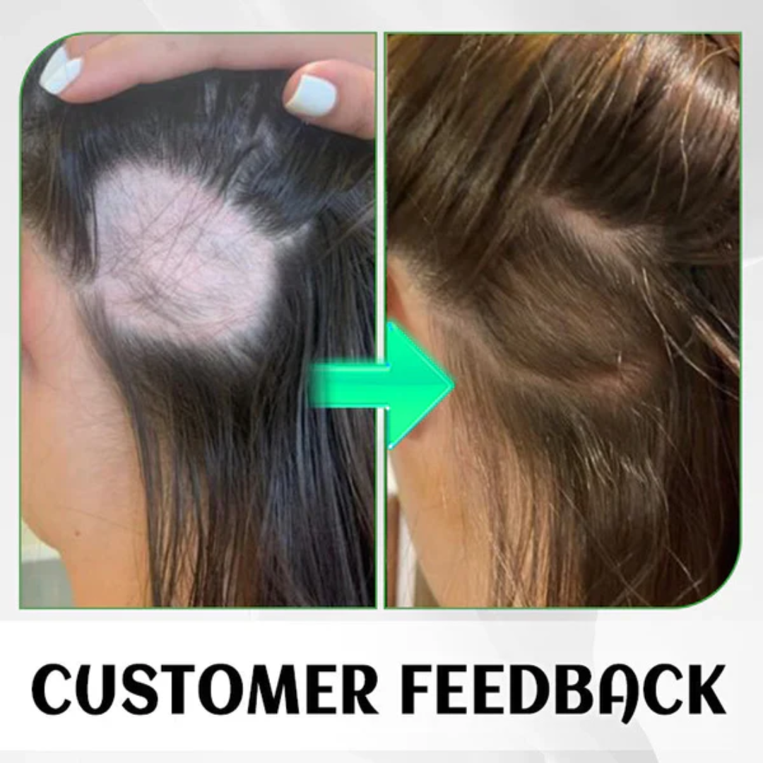🧔🏻‍♀️6.000 verkaufte Flaschen pro Tag in Europa🧔🏻‍♀️HAIRENEW™ FolliHerb Haarwuchs Spray