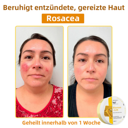 AEXZR™ Bienengift-Therapie-Creme, zur Behandlung von Ekzemen, Akne, Altersflecken, Krampfadern, Hautrissen