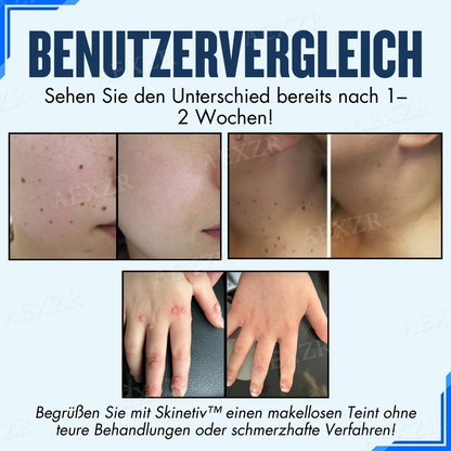 Skinetiv™ Maulwürfe & Warzen entfernen Haut-Tag-Pflaster