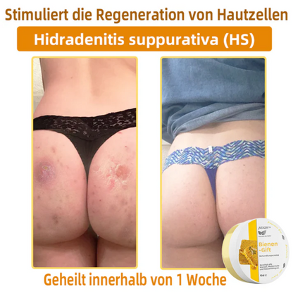 AEXZR™ Bienengift-Therapie-Creme, zur Behandlung von Ekzemen, Akne, Altersflecken, Krampfadern, Hautrissen