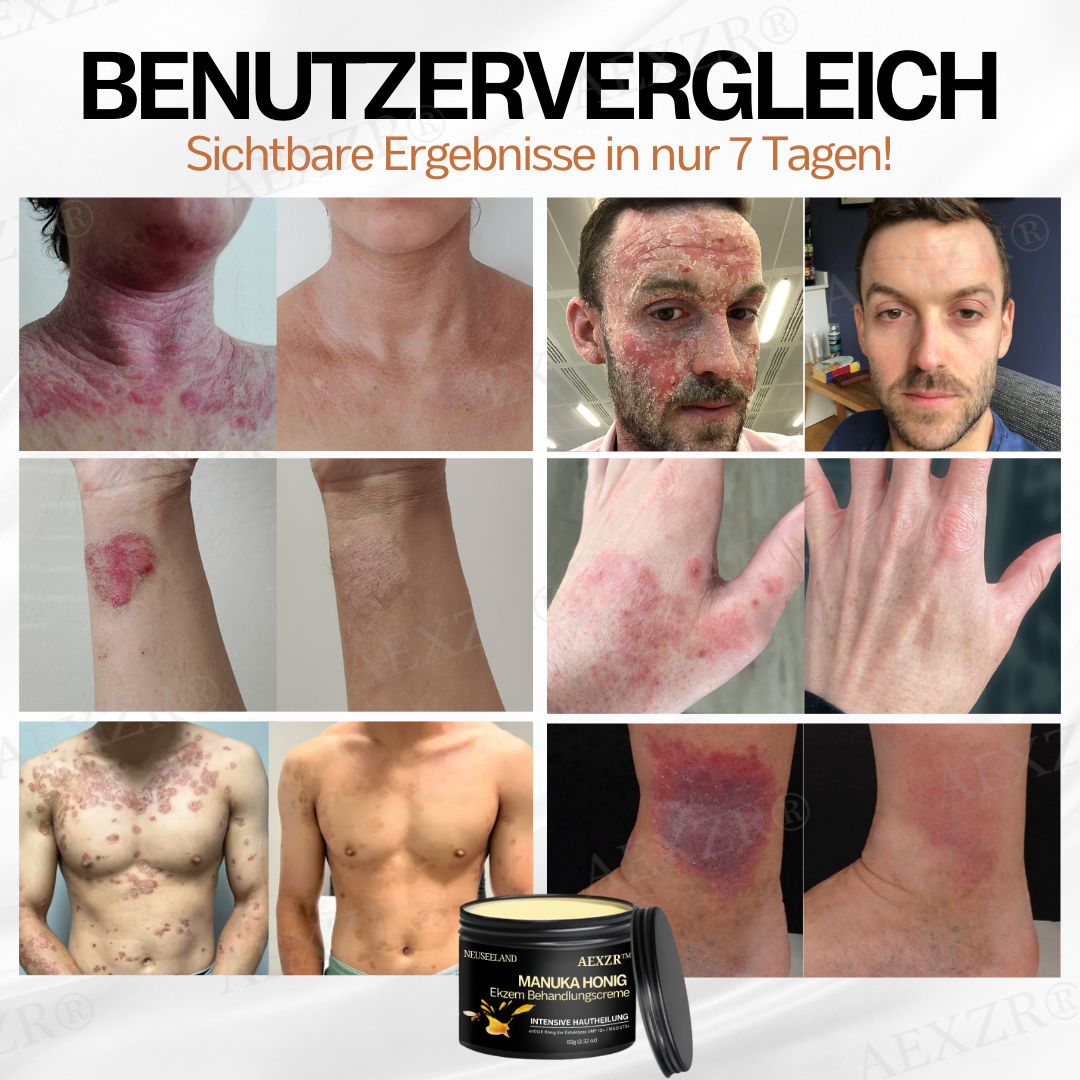 AEXZR™ Neuseeland Manuka Honig Ekzem Behandlungscreme