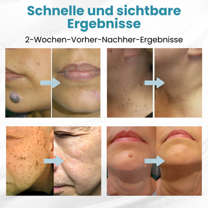 Bikenda® Nicht-invasive Muttermal- und Warzenbehandlung Laserstift zum Entfernen