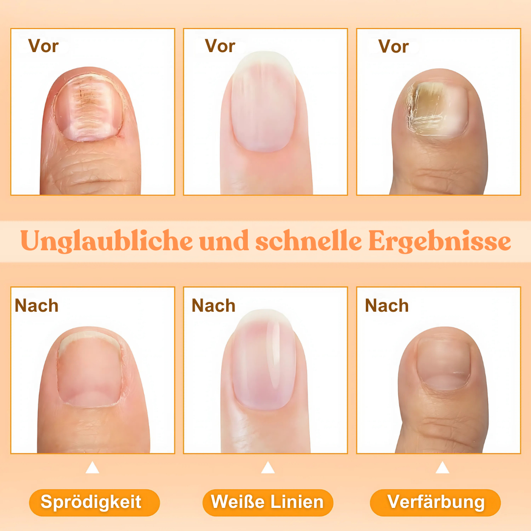 2024 HEISSER VERKAUF🔥AEXZR™ Bienengift Nagelreparatur Behandlungsspray🔥