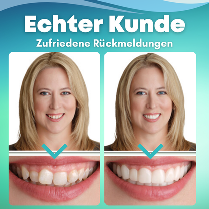 🔥2024 HEISSER VERKAUF🔥EzySmile™ SnapOn Silikon Veneers