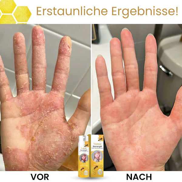 🐝Vuitoze™ Bienengift Ekzem Behandlung Spray🐝Die Wirkung wird in einer Woche eintreten