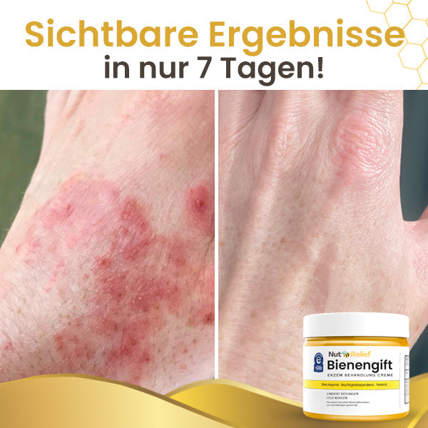 2024 HEISSER VERKAUF🔥NutRelief™ Bienengift Ekzem Behandlung Creme🔥